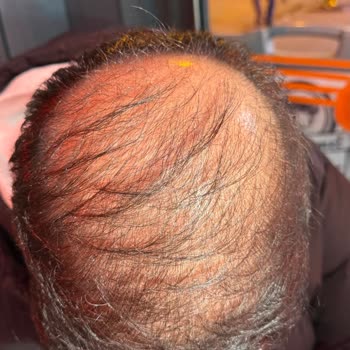 Ezgi Doğan Polikliniği Men Merkezinde Saç Tedavisi Fiyaskosu