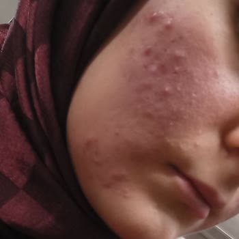 Tedavi Sonrası Cilt Sorunları Ve Müşteri Memnuniyetsizliği