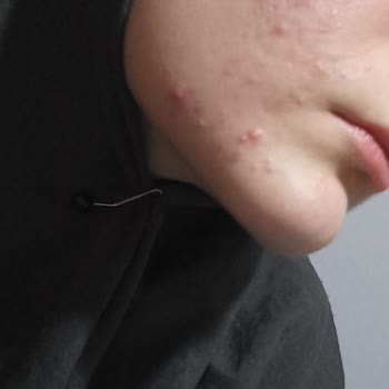 Tedavi Sonrası Cilt Sorunları Ve Müşteri Memnuniyetsizliği