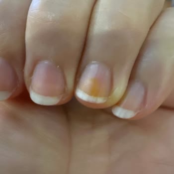 Flormar Oje Kullanımı Sonrası Tırnaklarda Kalıcı Lekeler