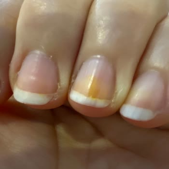 Flormar Oje Kullanımı Sonrası Tırnaklarda Kalıcı Lekeler