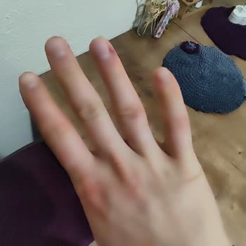 Neutrogena Krem Sonrası El Yanması Ve Döküntü