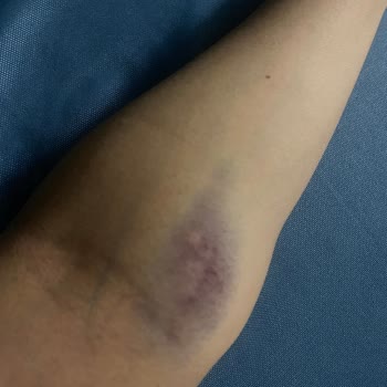 Yanlış Damar Seçimi Sonrası Şiddetli Ağrı Ve Morarma