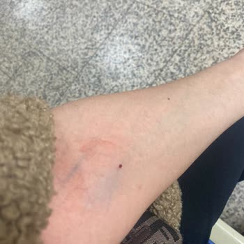 Yanlış Damar Seçimi Sonrası Şiddetli Ağrı Ve Morarma