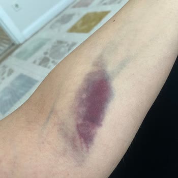 Yanlış Damar Seçimi Sonrası Şiddetli Ağrı Ve Morarma