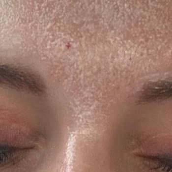 Uzm. Dr. Orhan Demirer Cildimde Yapılan Lazerin İzleri Mevcut