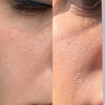 Uzm. Dr. Orhan Demirer Cildimde Yapılan Lazerin İzleri Mevcut