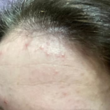 Yves Rocher Peeling Ve Maske Ürünleri Cilt Sorunlarına Yol Açtı