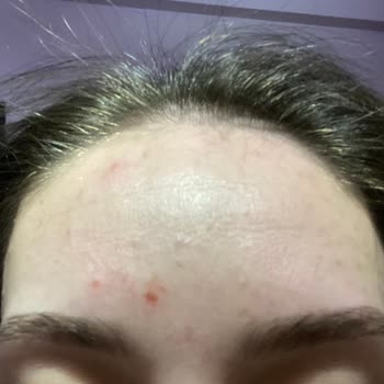 Yves Rocher Peeling Ve Maske Ürünleri Cilt Sorunlarına Yol Açtı