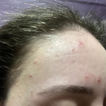 Yves Rocher Peeling Ve Maske Ürünleri Cilt Sorunlarına Yol Açtı