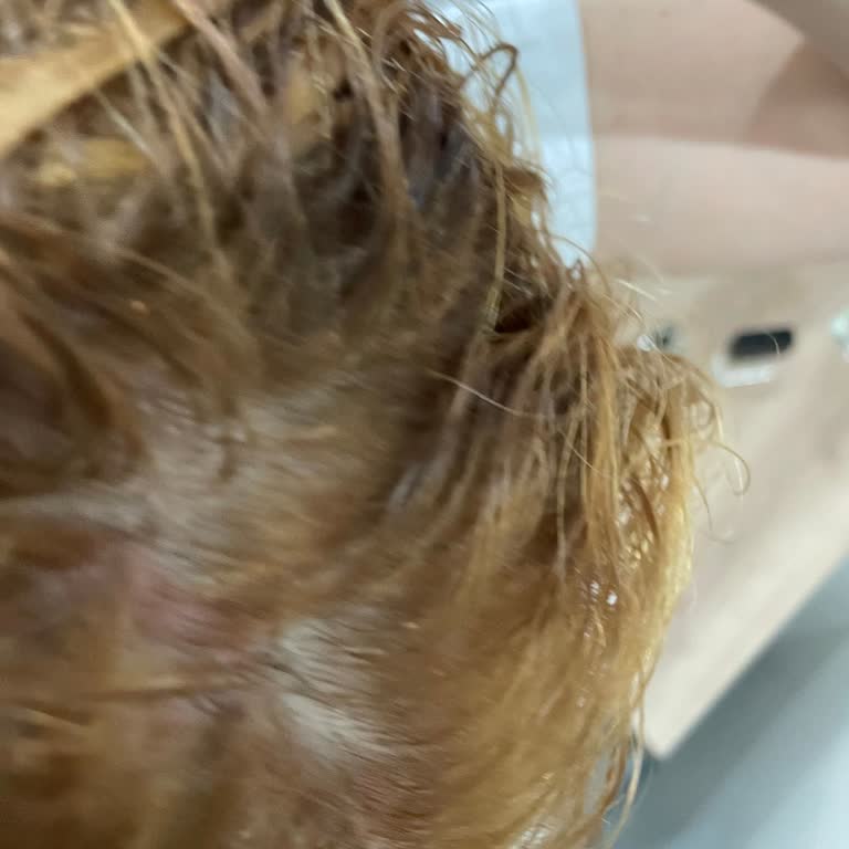 Saç Boyası Kullanımı Sonrası Cilt Sorunları