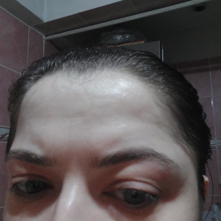 Revitalift Göz Serumu Kullanımında Şişlik Sorunu