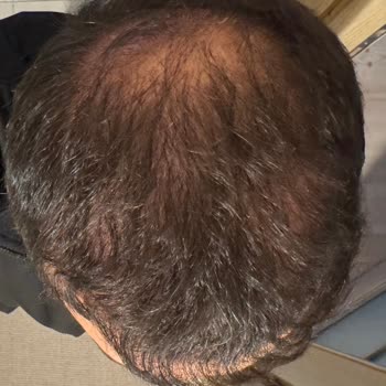 Doktor Değişikliği Ve İletişim Sorunlarıyla Saç Ekimi Hayal Kırıklığı