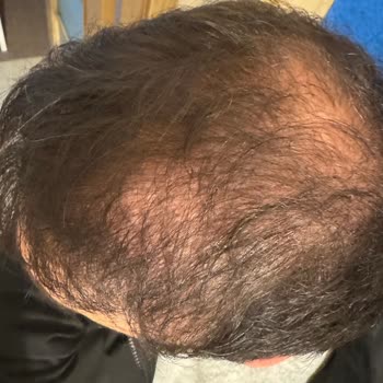 Doktor Değişikliği Ve İletişim Sorunlarıyla Saç Ekimi Hayal Kırıklığı