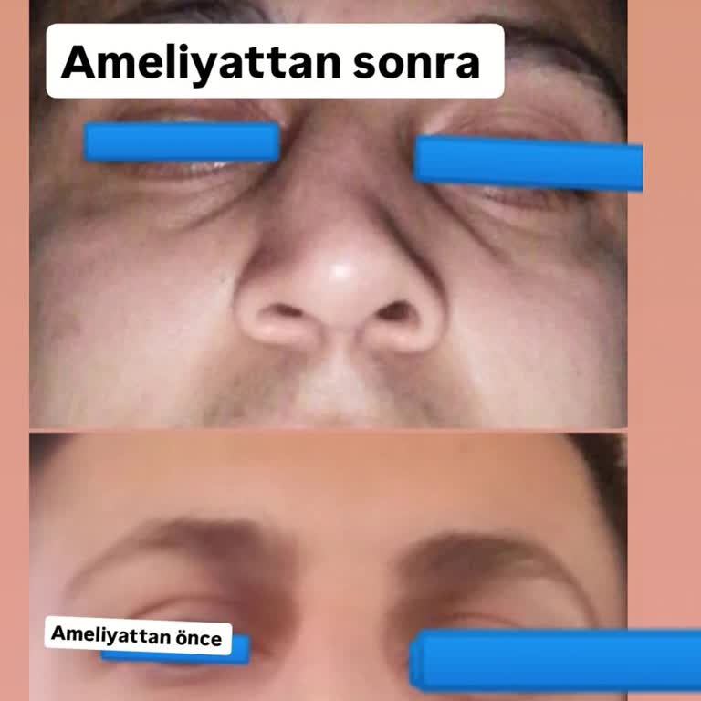 Başarısız Burun Ameliyatı Sonrası Artan Nefes Problemi
