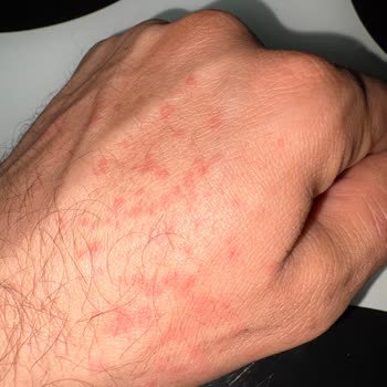 Clear Şampuan Kullanımı Sonrası Cilt Reaksiyonu