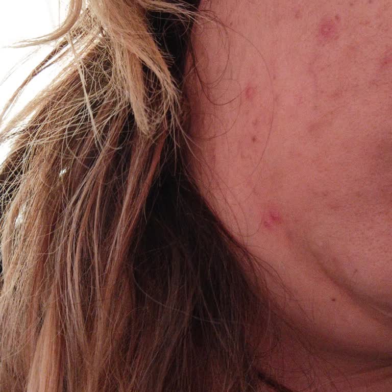 Flormar Fondöten Kullanımı Sonrası Cilt Sorunları