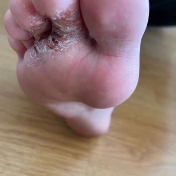 Skechers Kinder-Schuhe bekommen Risse und verursachen Fußwunden nach kurzer Nutzung