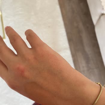 Mustela Ürünü Çocuğumda Alerji Yaptı