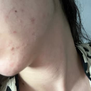 Cilt Sağlığımı Bozan Tonik Deneyimi