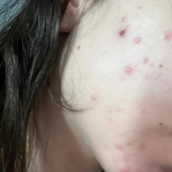 Cilt Sağlığımı Bozan Tonik Deneyimi