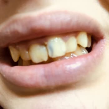 Tedavi Sürecinde Hayal Kırıklığı Ve Maddi Zorluklar