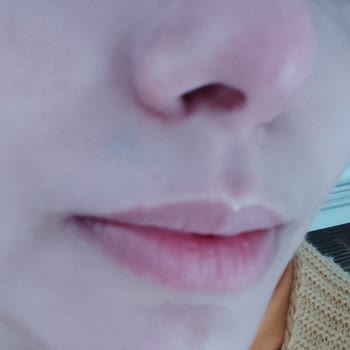 La Roche - Posay Cilt Nemlendirici Balsam Alerji Yaptı!