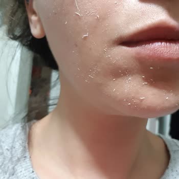 Bioderma Güneş Kremi Kullanım Sorunu