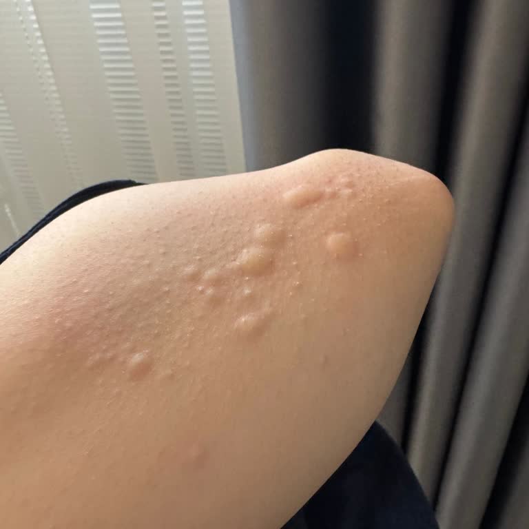 Bayat Balık Yüzünden Alerjik Kurdeşen