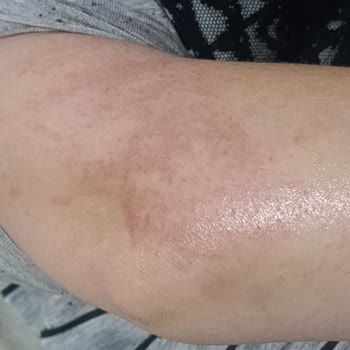 Tüy Dökücü Sprey Kullanımı Sonrası Ciddi Yanık Problemi