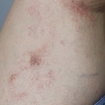 Tüy Dökücü Sprey Kullanımı Sonrası Ciddi Yanık Problemi