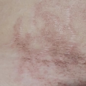 Tüy Dökücü Sprey Kullanımı Sonrası Ciddi Yanık Problemi