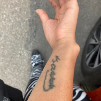 Yarım Kalan Dövme Silme İşlemi Ve Mağduriyet