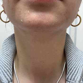 Yves Rocher Ürünleri Cildimde Soyulma Yaptı