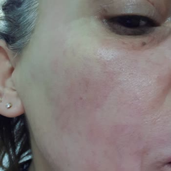 Bioderma Ürünleri Cildimde Sorun Yarattı