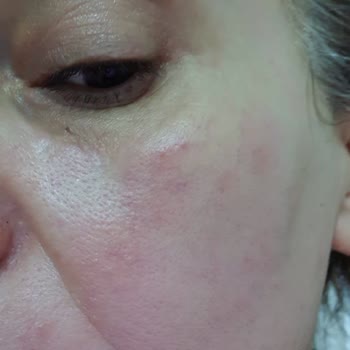 Bioderma Ürünleri Cildimde Sorun Yarattı