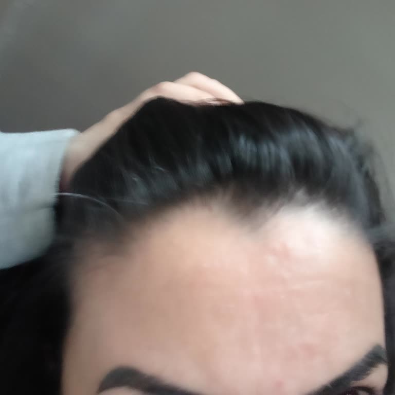 L'Oreal Krem Kullanımı Sonrası Sivilce Problemi