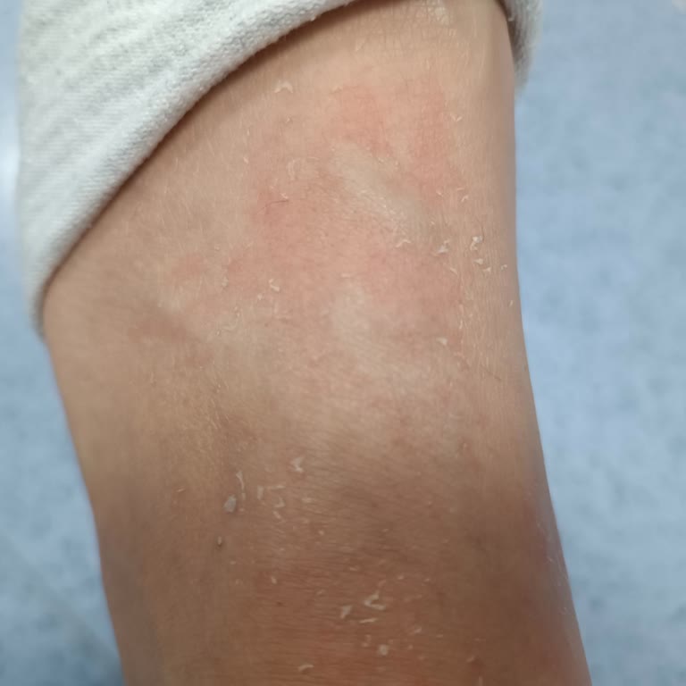 Ayak Maskesi Kullanımında Cilt Sorunları