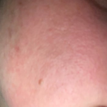 Nivea Yüz Temizleme Jeli Cildimde Yanma Ve Kızarıklığa Sebep Oldu