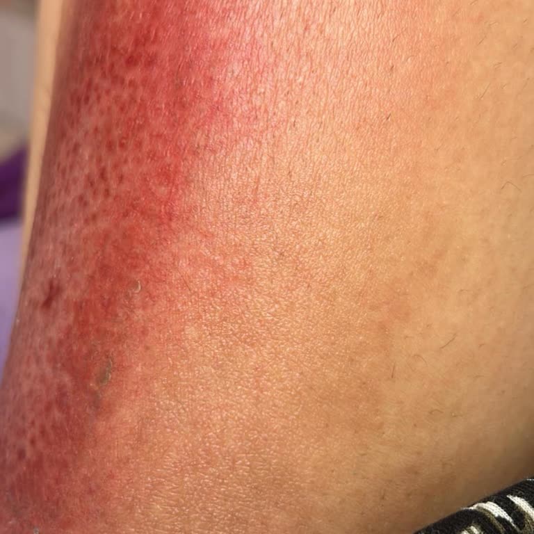 Fatma Özçalışkan Güzellik Kimyasal Peeling Sonrası Kalıcı Leke Ve Acı