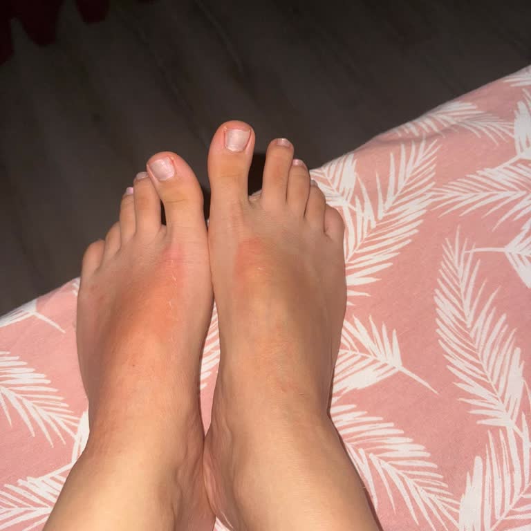 Dermokil Ayak Maskesi Tahriş Ve Kaşıntı Sorunu