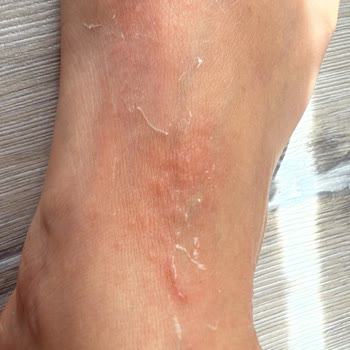 Dermokil Ayak Maskesi Tahriş Ve Kaşıntı Sorunu