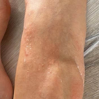 Dermokil Ayak Maskesi Tahriş Ve Kaşıntı Sorunu