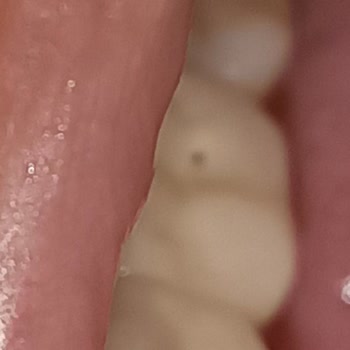 Dentakay’s Poor Porcelain Crown Work—Pain, Visible Metal, and Failed Treatments