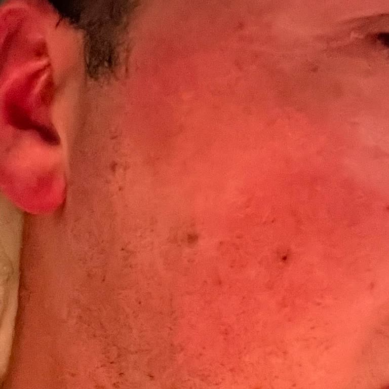 Yves Rocher Cilt Bakım Ürününde Beklenmedik Yan Etkiler Ve İlgisiz Müşteri Hizmetleri