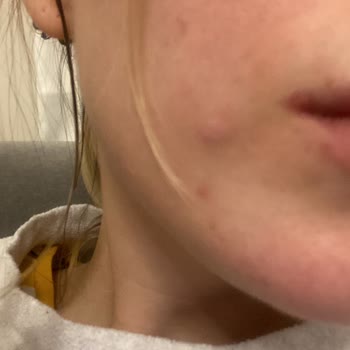 Botanik City Çenemin Yanında Alerjik Kabartı Oluştu