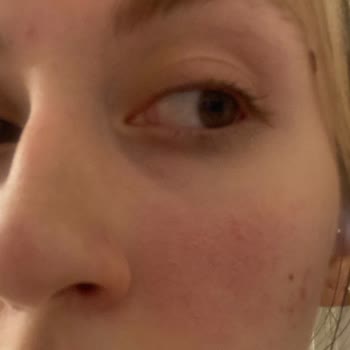 Botanik City Çenemin Yanında Alerjik Kabartı Oluştu