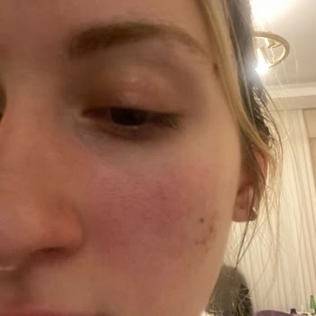 Botanik City Çenemin Yanında Alerjik Kabartı Oluştu