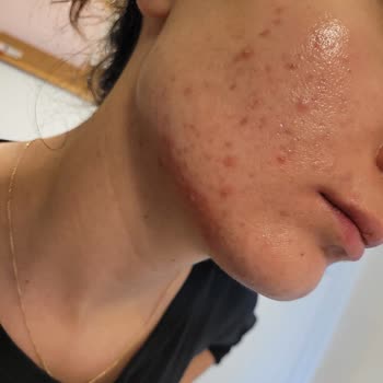 Vitakobal B12 Kullanımı Sonrası Cilt Problemleri Ve Mağduriyet