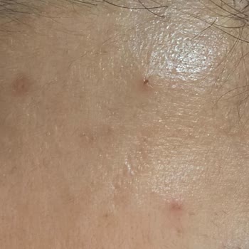 Ürünler Sivilce Sorununu Çözmedi, Aksine Artırdı